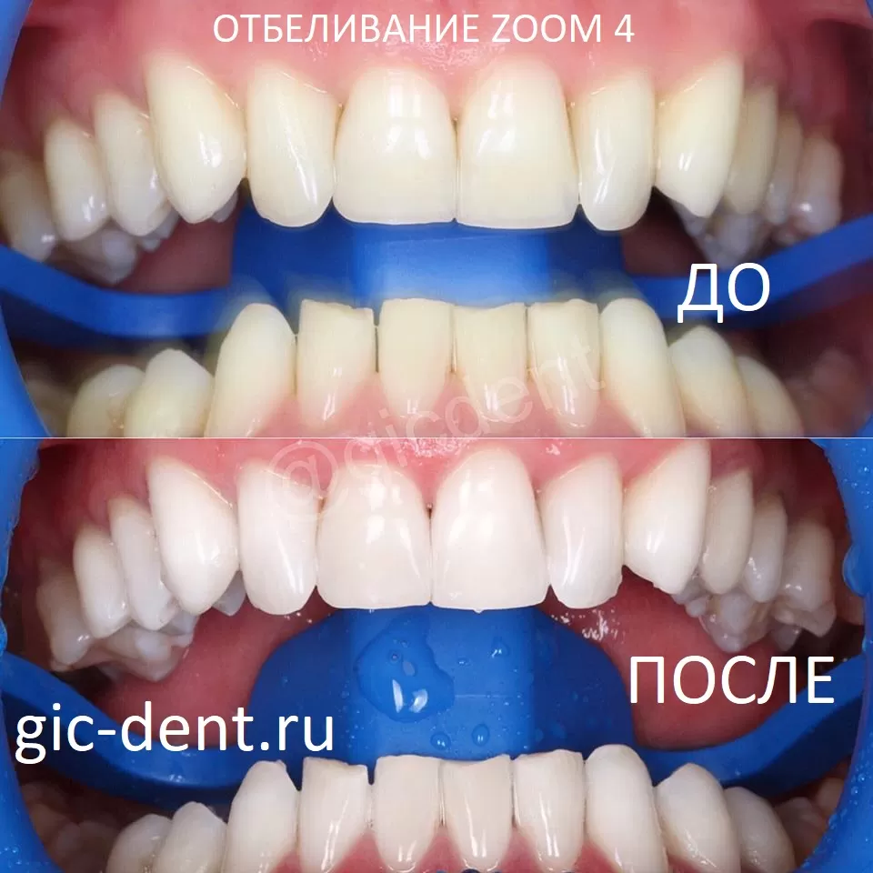 Отбеливание зубов ZOOM4 Немецком имплантологическом центре